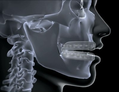 forsus braces mouth guard
